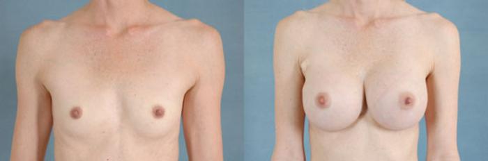 Before & After Breast Augmentation Case 211 View #1 View in Tallahassee, FL
