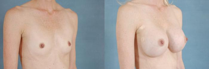 Before & After Breast Augmentation Case 211 View #2 View in Tallahassee, FL