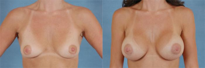 Before & After Breast Augmentation Case 212 View #1 View in Tallahassee, FL