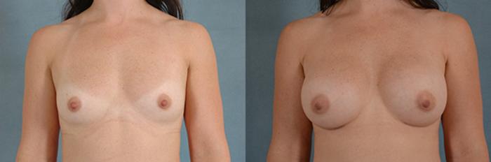 Before & After Breast Augmentation Case 213 View #1 View in Tallahassee, FL