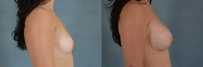Before & After Breast Augmentation Case 213 View #2 View in Tallahassee, FL