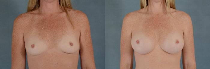 Before & After Breast Augmentation Case 214 View #1 View in Tallahassee, FL