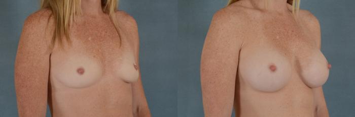 Before & After Breast Augmentation Case 214 View #2 View in Tallahassee, FL