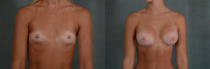 Before & After Breast Augmentation Case 262 View #1 View in Tallahassee, FL