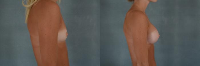 Before & After Breast Augmentation Case 262 View #2 View in Tallahassee, FL
