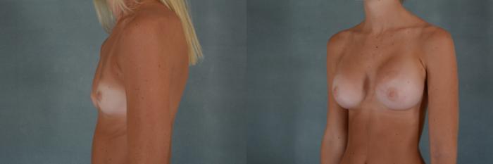 Before & After Breast Augmentation Case 262 View #3 View in Tallahassee, FL