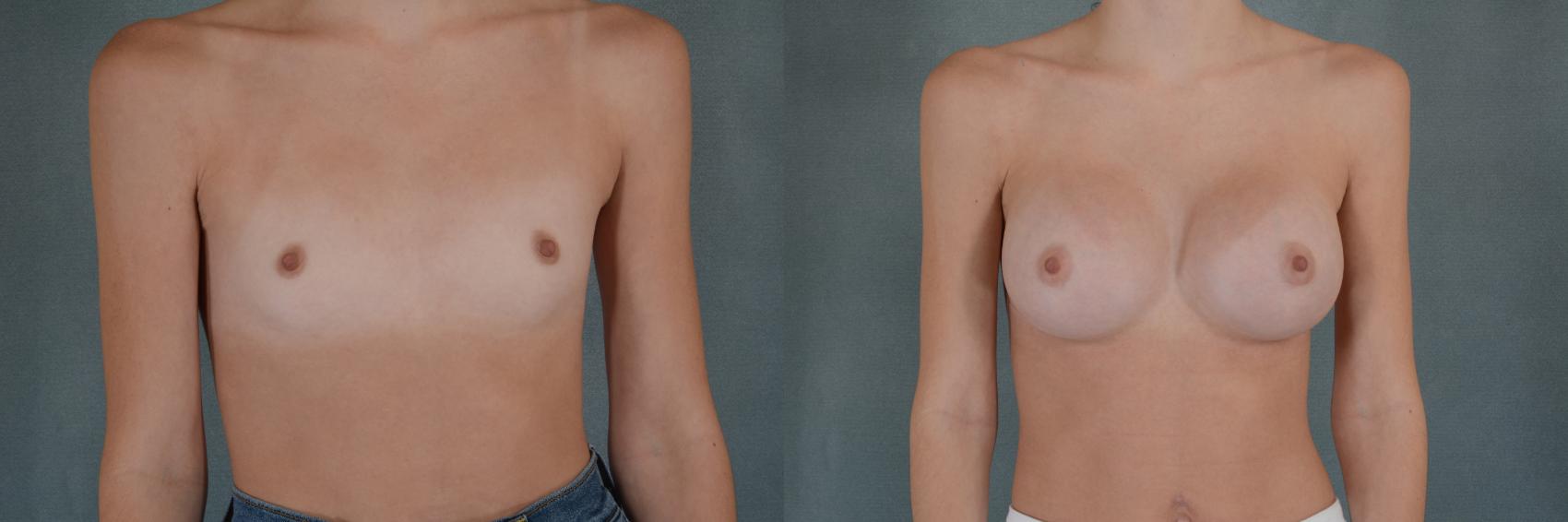 Before & After Breast Augmentation Case 287 View #1 View in Tallahassee, FL