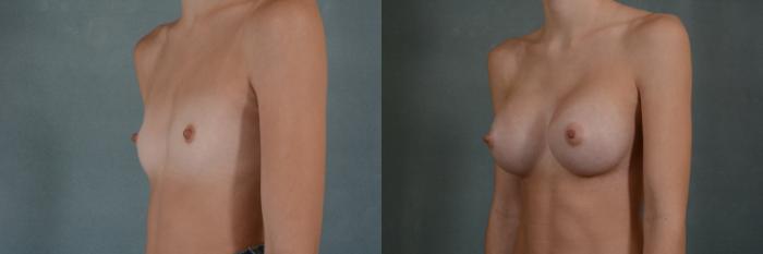 Before & After Breast Augmentation Case 287 View #2 View in Tallahassee, FL