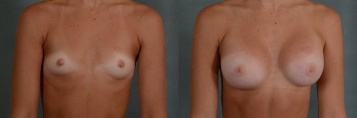 Before & After Breast Augmentation Case 289 View #1 View in Tallahassee, FL