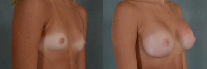 Before & After Breast Augmentation Case 289 View #2 View in Tallahassee, FL