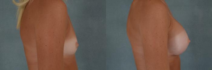 Before & After Breast Augmentation Case 289 View #3 View in Tallahassee, FL