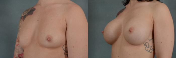 Before & After Breast Augmentation Case 294 View #2 View in Tallahassee, FL