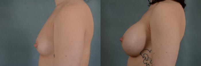 Before & After Breast Augmentation Case 294 View #3 View in Tallahassee, FL