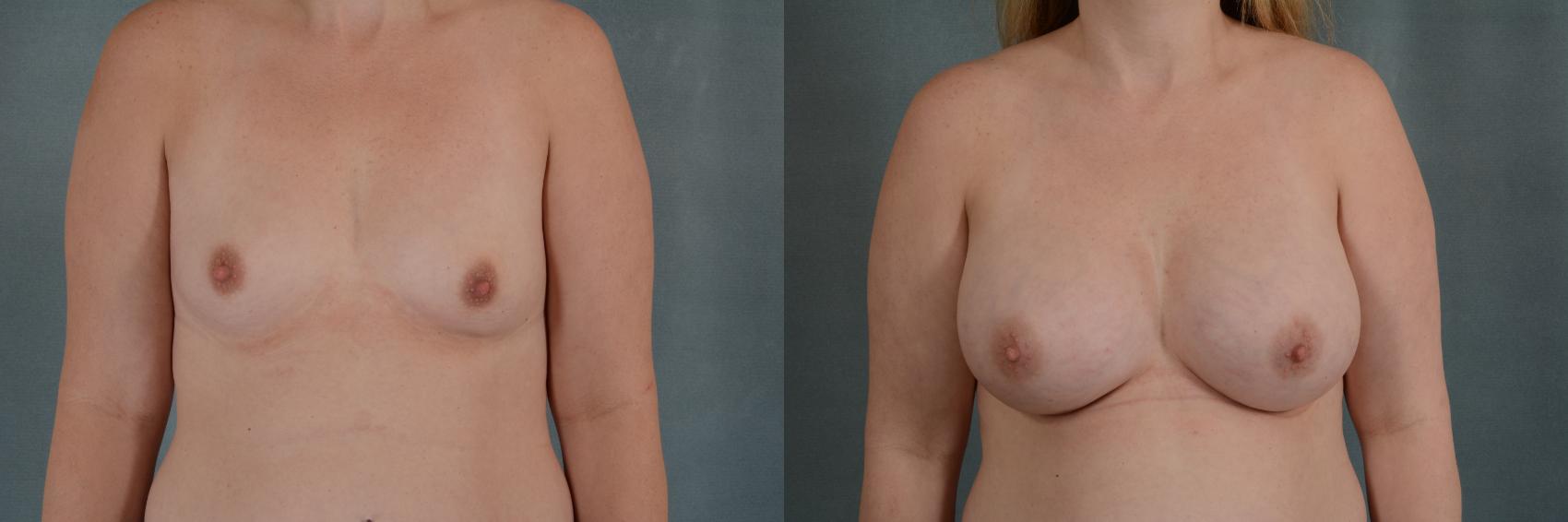 Before & After Breast Augmentation Case 317 View #1 View in Tallahassee, FL