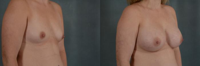 Before & After Breast Augmentation Case 317 View #2 View in Tallahassee, FL