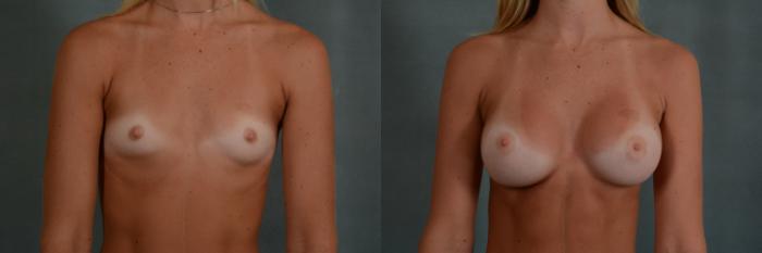 Before & After Breast Augmentation Case 329 View #1 View in Tallahassee, FL