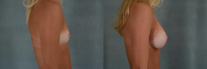 Before & After Breast Augmentation Case 329 View #2 View in Tallahassee, FL