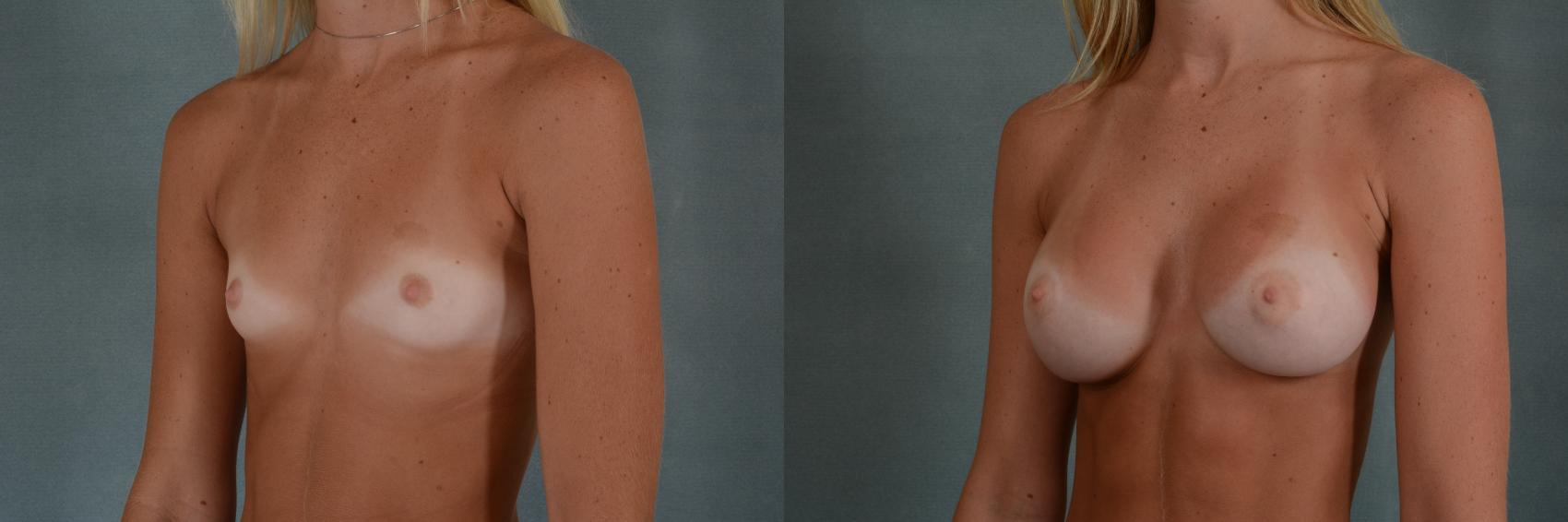 Before & After Breast Augmentation Case 329 View #3 View in Tallahassee, FL