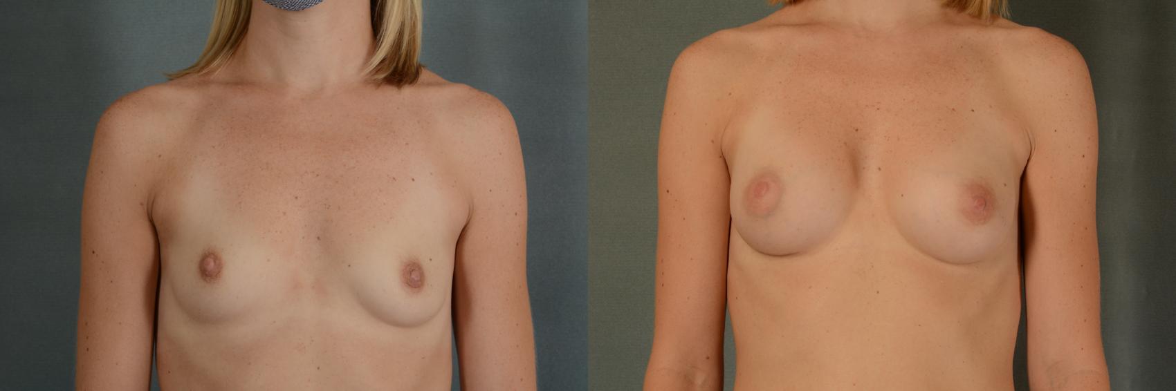 Before & After Breast Augmentation Case 390 View #1 View in Tallahassee, FL