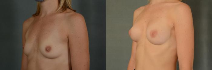 Before & After Breast Augmentation Case 390 View #2 View in Tallahassee, FL