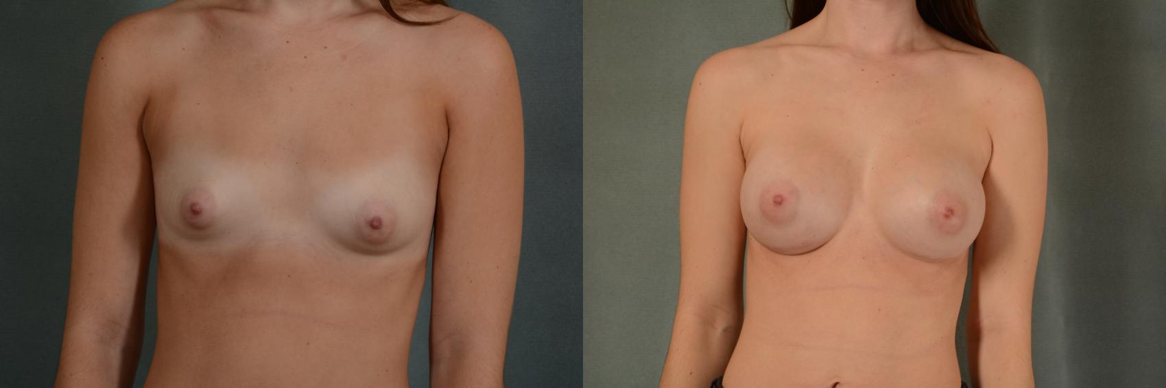 Before & After Breast Augmentation Case 397 View #1 View in Tallahassee, FL