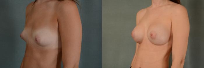 Before & After Breast Augmentation Case 397 View #2 View in Tallahassee, FL