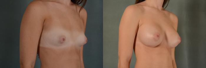 Before & After Breast Augmentation Case 397 View #3 View in Tallahassee, FL
