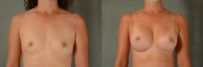 Before & After Breast Augmentation Case 427 View #1 View in Tallahassee, FL