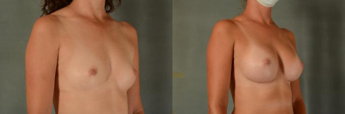 Before & After Breast Augmentation Case 427 View #2 View in Tallahassee, FL
