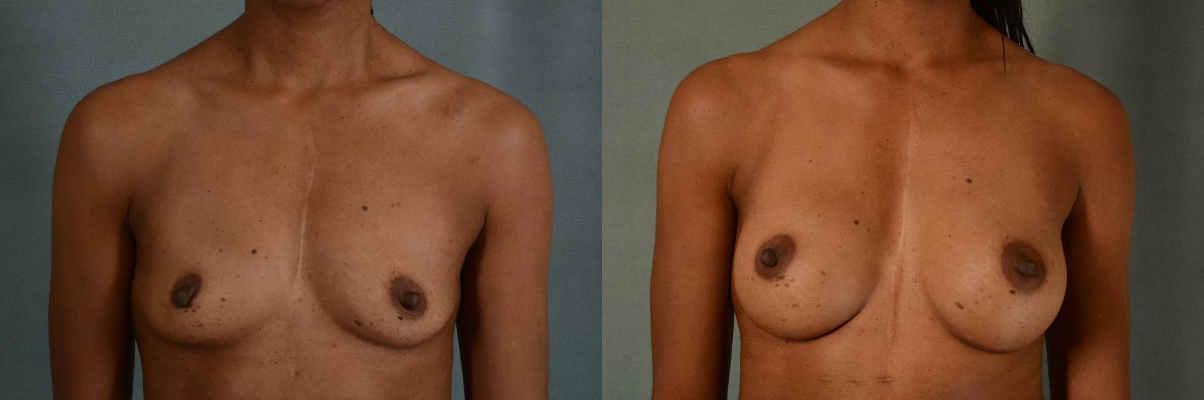 Before & After Breast Augmentation Case 428 View #1 View in Tallahassee, FL