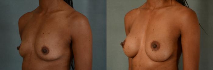 Before & After Breast Augmentation Case 428 View #2 View in Tallahassee, FL