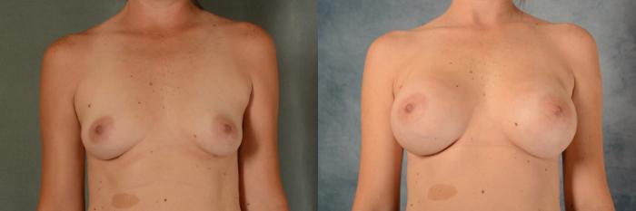 Before & After Breast Augmentation Case 462 Front View in Tallahassee, FL