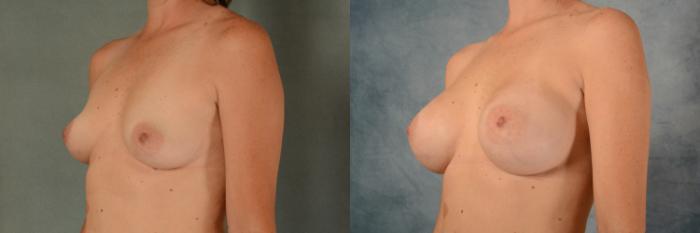 Before & After Breast Augmentation Case 462 Left Oblique View in Tallahassee, FL