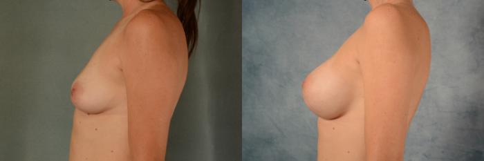 Before & After Breast Augmentation Case 462 Left Side View in Tallahassee, FL