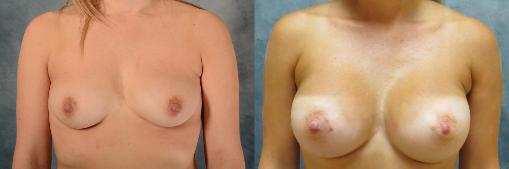 Before & After Breast Augmentation Case 488 Front View in Tallahassee, FL