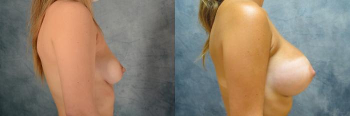 Before & After Breast Augmentation Case 488 Right Side View in Tallahassee, FL