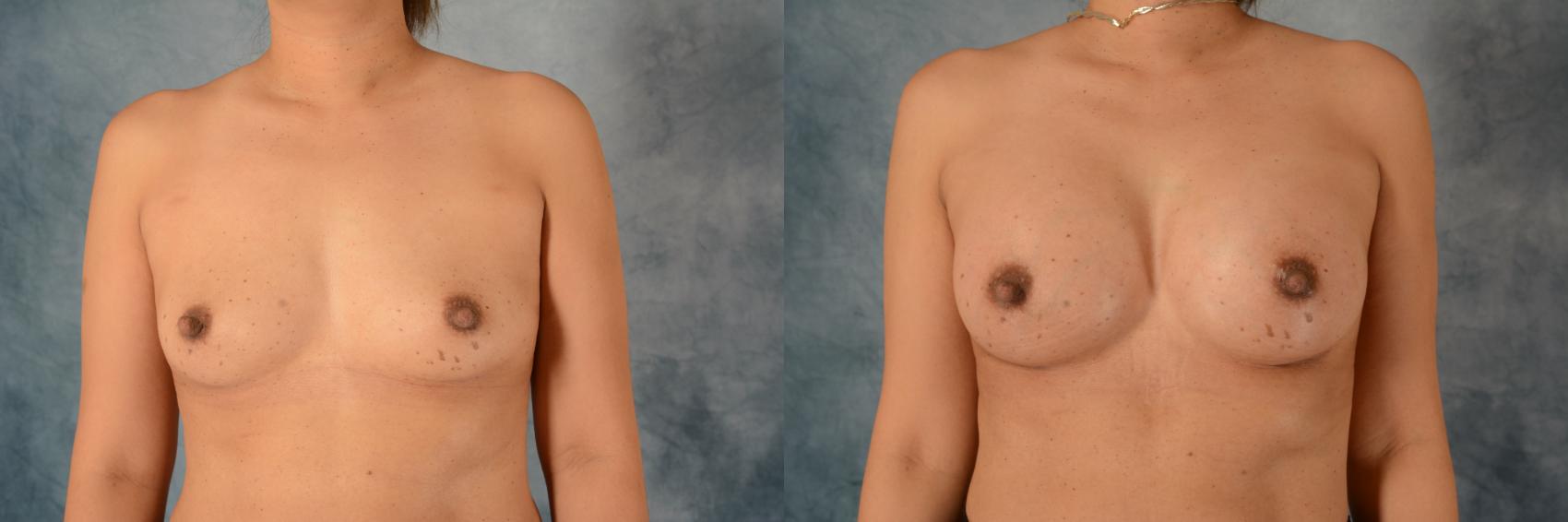 Before & After Breast Augmentation Case 517 Front View in Tallahassee, FL