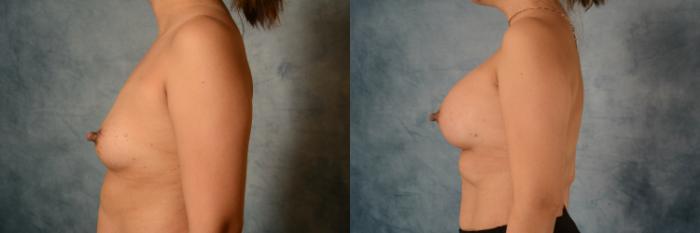 Before & After Breast Augmentation Case 517 Left Side View in Tallahassee, FL