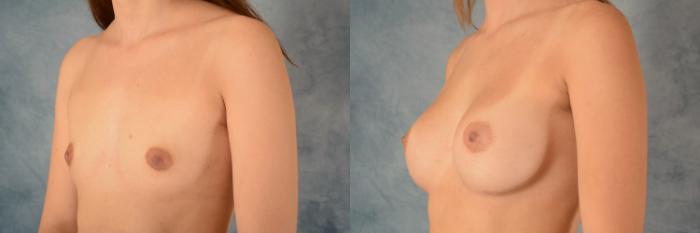 Before & After Breast Augmentation Case 537 Left Oblique View in Tallahassee, FL