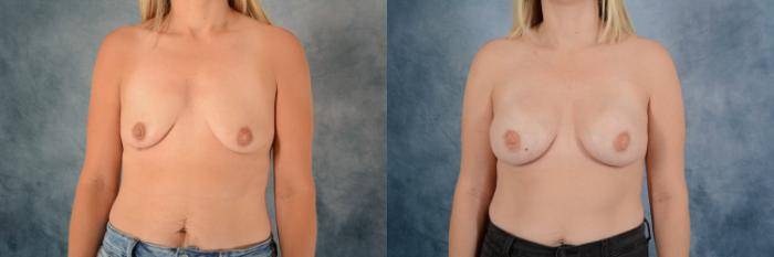 Before & After Breast Augmentation Case 618 Front View in Tallahassee, FL
