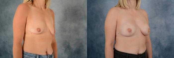 Before & After Breast Augmentation Case 618 Right Oblique View in Tallahassee, FL