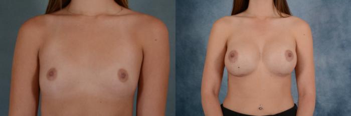 Before & After Breast Augmentation Case 625 Front View in Tallahassee, FL