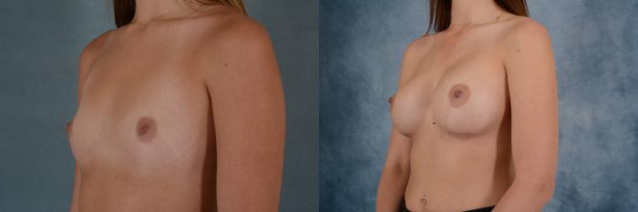 Before & After Breast Augmentation Case 625 Left Oblique View in Tallahassee, FL