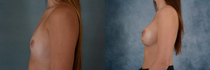Before & After Breast Augmentation Case 625 Left Side View in Tallahassee, FL