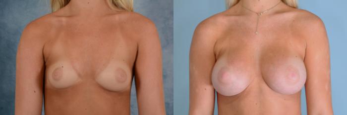 Before & After Breast Augmentation Case 640 Front View in Tallahassee, FL