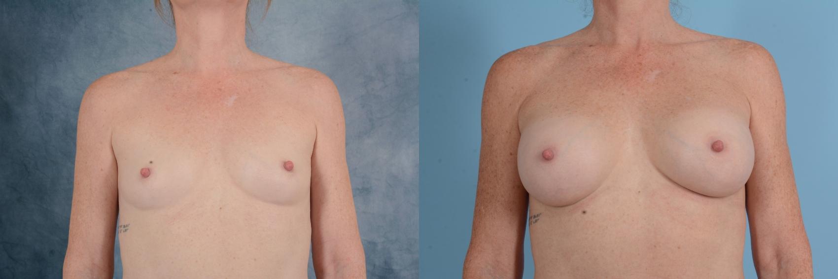 Before & After Breast Augmentation Case 669 Front View in Tallahassee, FL