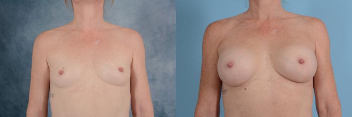 Before & After Breast Augmentation Case 669 Front View in Tallahassee, FL