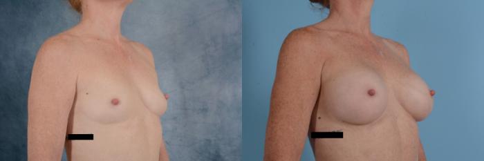 Before & After Breast Augmentation Case 669 Right Oblique View in Tallahassee, FL