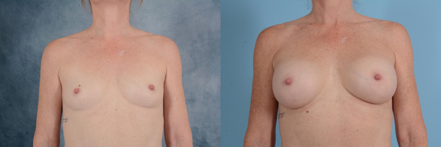Before & After Breast Augmentation Case 725 Front View in Tallahassee, FL