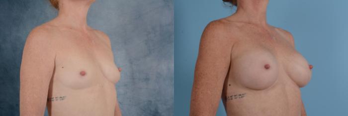 Before & After Breast Augmentation Case 725 Right Oblique View in Tallahassee, FL